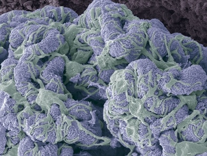 Metabolic deregulation, genome instability, and the progression of chronic kidney disease